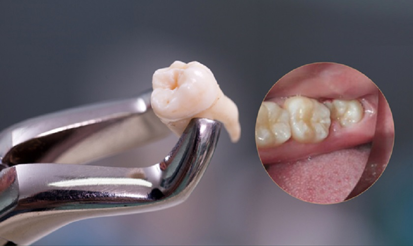 Nhổ Răng Khôn Bao Lâu Thì Lành? | Phòng khám đa khoa quốc tế An Đạt mong  muốn chung tay góp sức cho ngành y tế nước nhà tạo nên một cộng